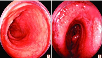کولیت اولسروز